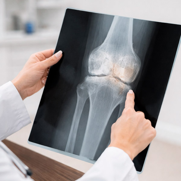 artrosis de rodilla